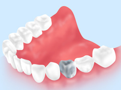 歯科技工物の交換